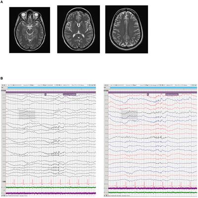 Safe and effective implantation and use of vagal nerve stimulation in new-onset refractory status epilepticus in early pregnancy: a case report